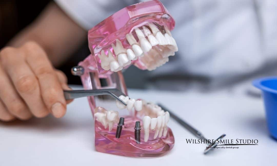 All on Implants Benefits All on Implants Benefits