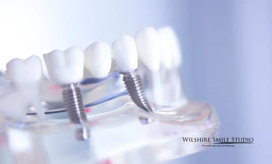 Best Dentist for Your All on Treatment Best Dentist for Your All on Treatment