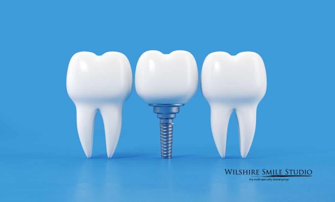 Best Time to Consider All on Implants Best Time to Consider All on Implants