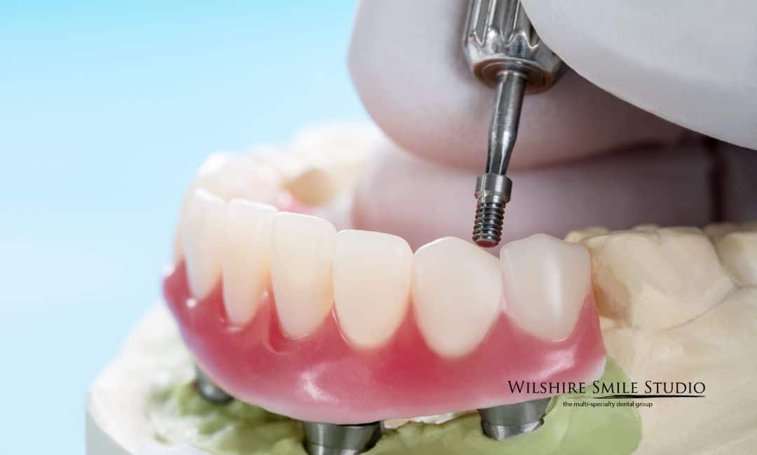 all on implants Cost and Insurance Coverage all on implants Cost and Insurance Coverage