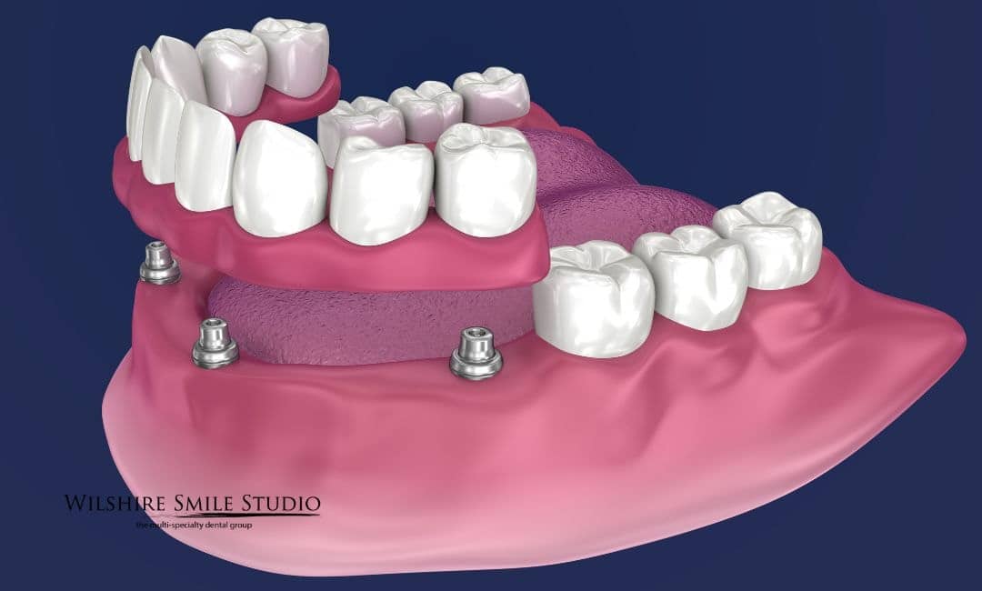 all on implants explained all on implants explained