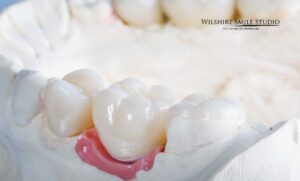 dental crown faqs dental crown faqs