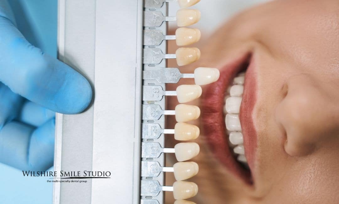 candidate for veneers candidate for veneers