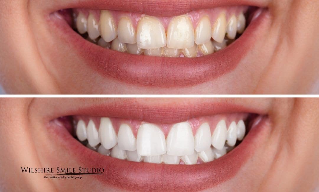 get ready for teeth whitening get ready for teeth whitening