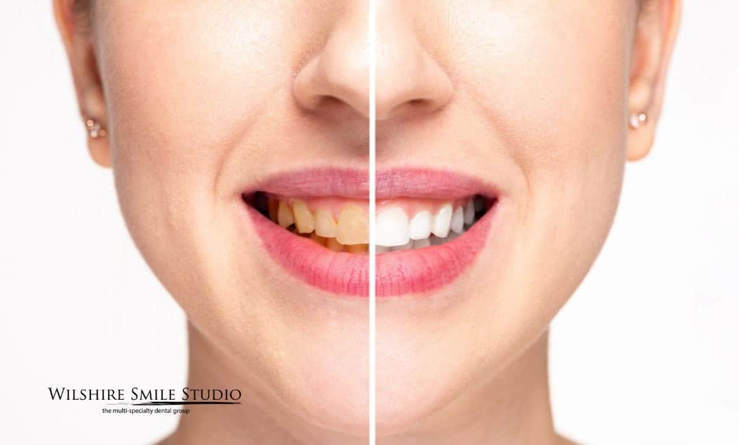 teeth whitening cost insurance teeth whitening cost insurance