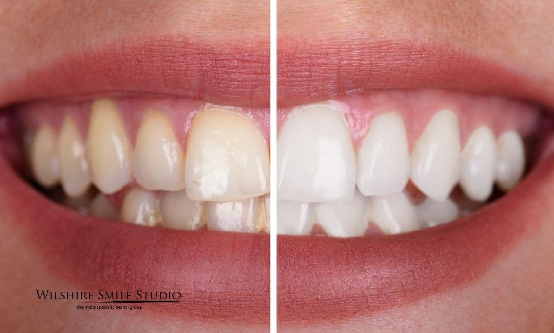 teeth whitening explained teeth whitening explained