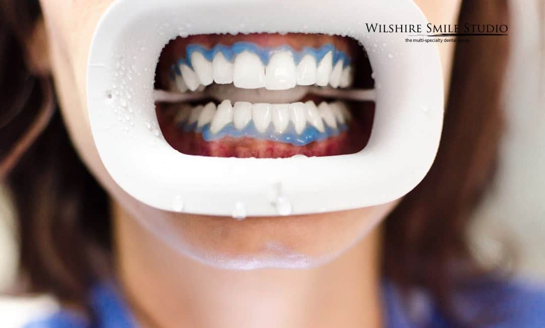 teeth whitening procedure teeth whitening procedure