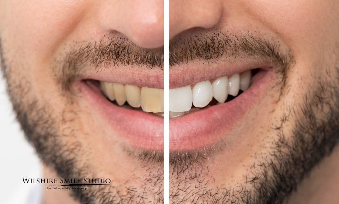 why choose wilshire smile studio for teeth whitening why choose wilshire smile studio for teeth whitening