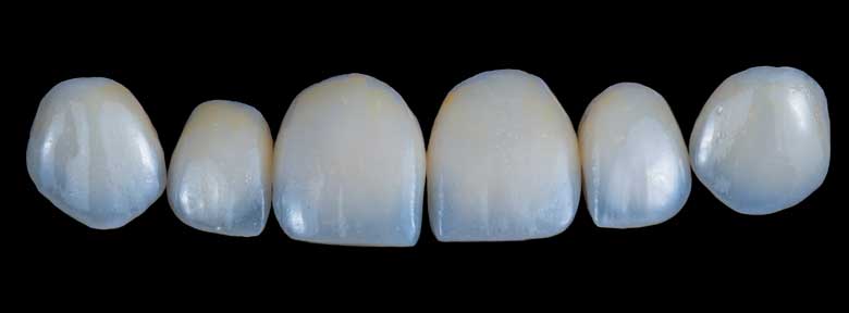 Porcelain Veneers blog Porcelain Veneers blog