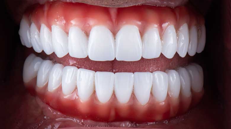 Porcelain Veneers Porcelain Veneers