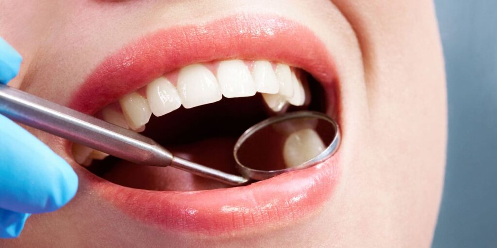 Dental Fillings