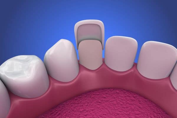 Emergency Veneers Wilshire Smile Studio