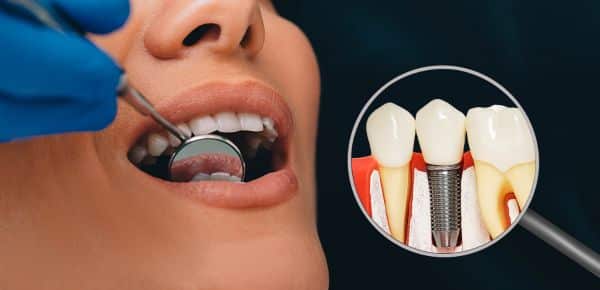 Dental Implants in Los Angeles